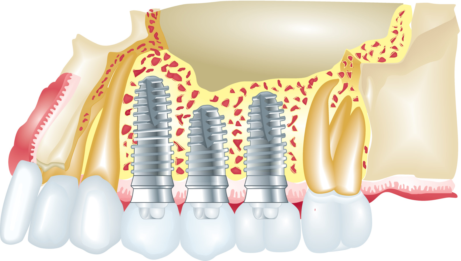 dental implants with nanotechnology